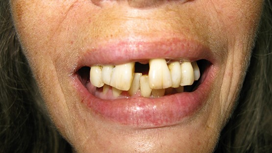 Dentures Problems Rosepine LA 70659